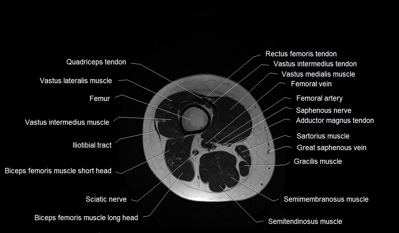 MRI thigh cross sectional anatomy image 46.webp